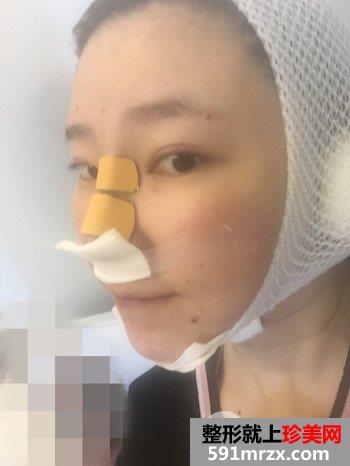 貴陽當代醫療美容醫院整形價格表|隆鼻失敗修復真實案例分享 貴陽當代醫療美容醫院整形價格表|隆鼻失敗修復真實案例分享