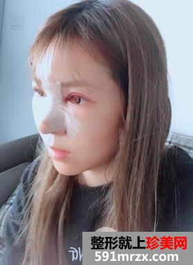 天津維美醫(yī)療美容醫(yī)院整形價(jià)格表,隆鼻案例效果前后對(duì)比圖分享 天津維美醫(yī)療美容醫(yī)院整形價(jià)格表,隆鼻案例效果前后對(duì)比圖分享